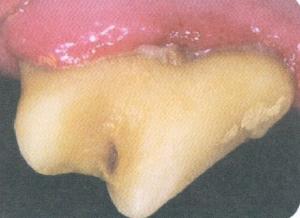 Established Periodontal Disease