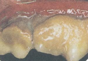  Advanced Periodontal Disease